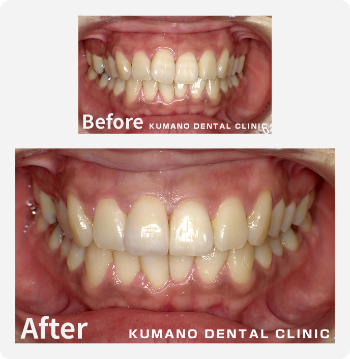 前歯部審美治療の症例02 | 春日井市の歯科医院 くまの歯科